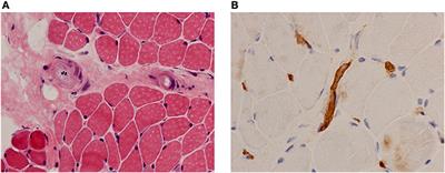 The Vasculopathy of Juvenile Dermatomyositis